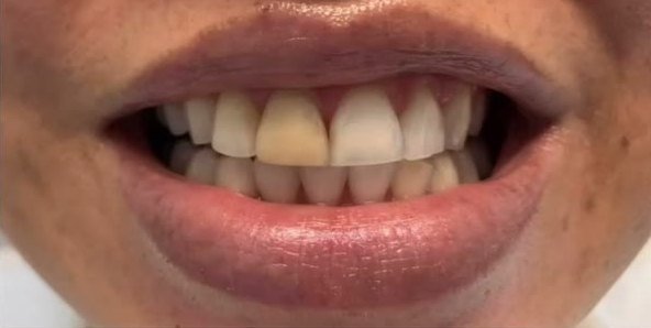 Antes do tratamento: dentes desalinhados e escurecidos, paciente do Dr. Marcelo Marques