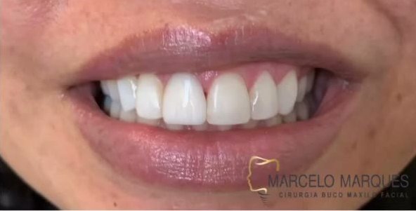 Depois: sorriso reabilitado com estética do sorriso em João Monlevade