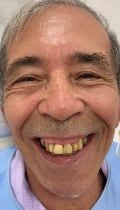 Antes: dentes desgastados e escurecidos
