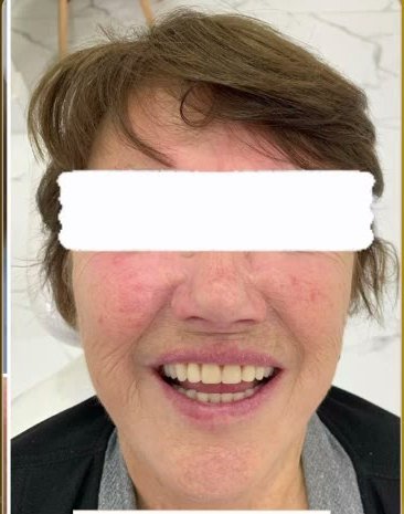 Depois: sorriso reabilitado com prótese protocolo em João Monlevade