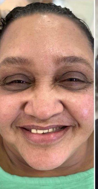 Antes: paciente com dentes perdidos e falhas