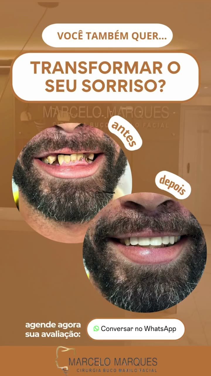 Antes e depois de reabilitação do sorriso com implantes
