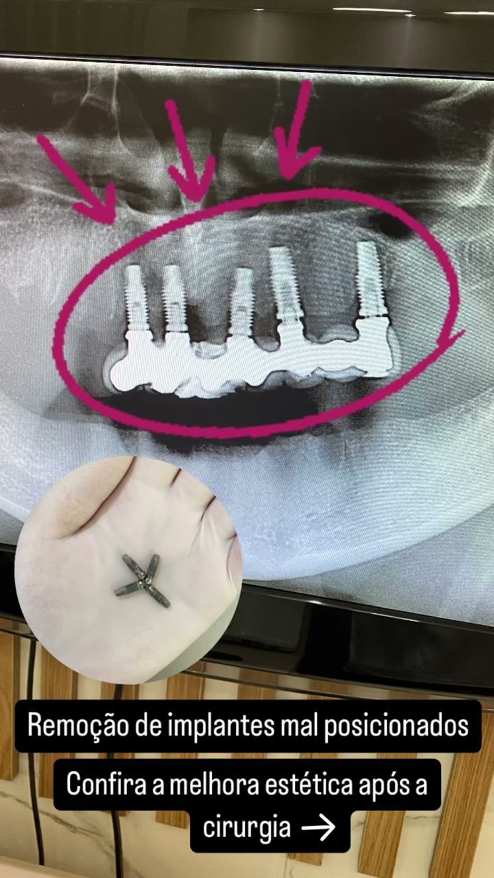 Cirurgia de remoção de implantes mal posicionados